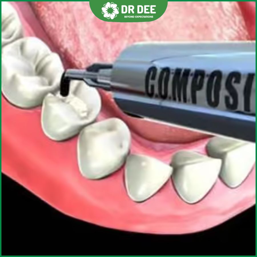 Gỡ miếng trám răng có đau không? Hiểu rõ để an tâm hơn